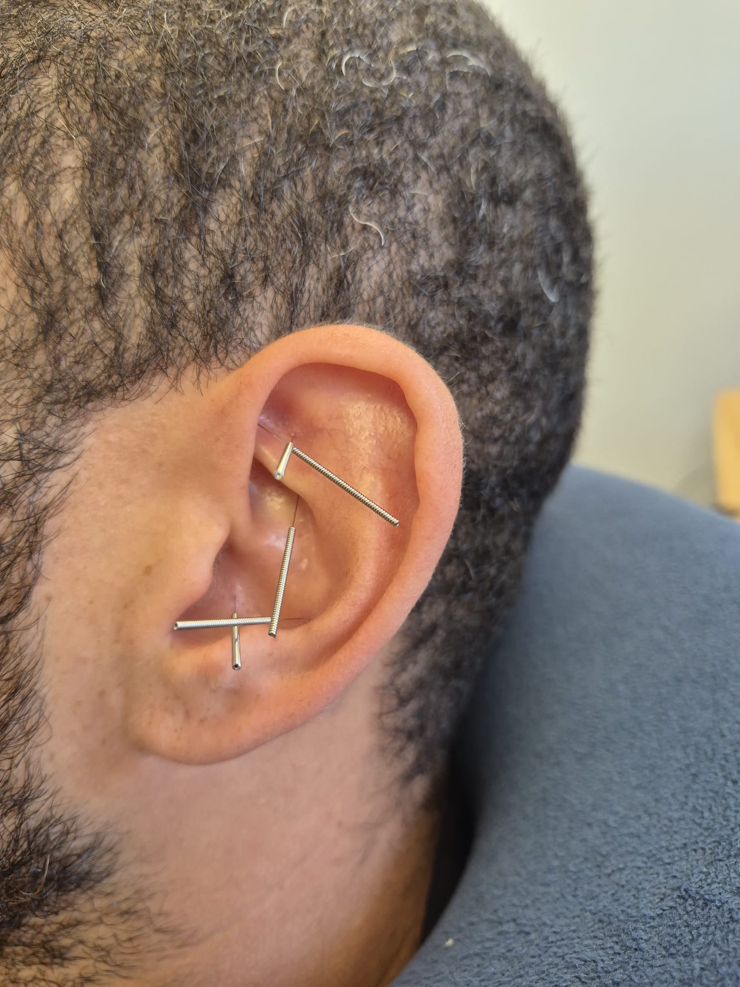 דיקור עדין בנקודות פרוטוקול NADA באוזן